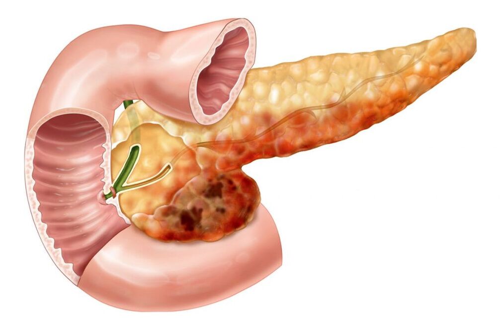 dureri de spate din cauza pancreatitei