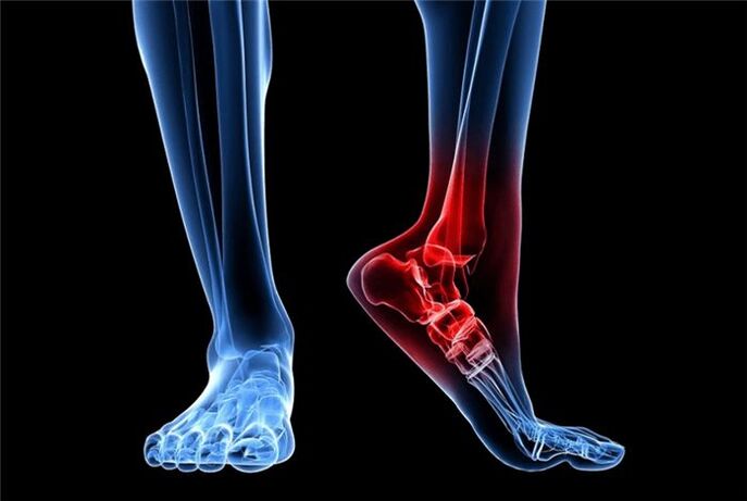 artroza piciorului