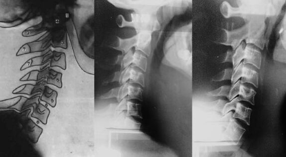 Gât cu o deplasare a primei vertebre cervicale