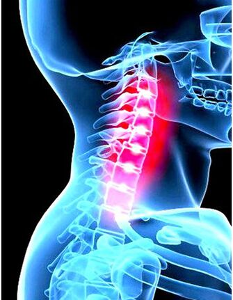 Imaginea clinică a osteochondrozei
