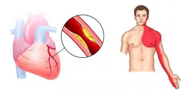 Sindromul cardial